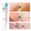 Treatment Acid Gel Removal Pimple Blackhead Shrinking Pore Whitening Repair Face Cream