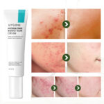 Treatment Acid Gel Removal Pimple Blackhead Shrinking Pore Whitening Repair Face Cream
