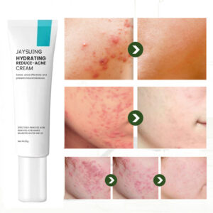 Treatment Acid Gel Removal Pimple Blackhead Shrinking Pore Whitening Repair Face Cream