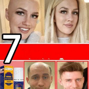 Hair Growth Spray Products for Men and Women, Ginger Anti-hair Loss, Rapid Regeneration,Thickening, Oil Control,