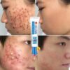 Acne Treatment Mild Oil Control Pimple Spot Removal Fade Acne Marks Natural Herbal Skin Care Anti-acne Gel