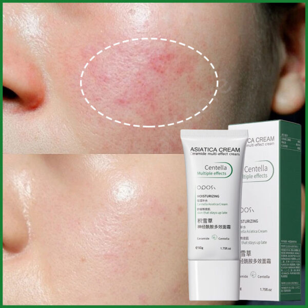 Fast Repair Facial Redness Cream Sooth Itching Sensitive Skin Improve Rosacea Remove Acne Nourish Facial Skin Korean