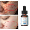 Freckles Removal Essence Whitening And Freckle Removing Cream Remove Facial Spots Skin Dark Spot Remove Melasma