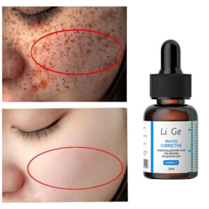 Freckles Removal Essence Whitening And Freckle Removing Cream Remove Facial Spots Skin Dark Spot Remove Melasma
