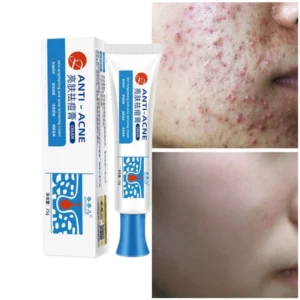 Salicylic Acne Face Gel Pimple For Teens Blackhead Removal Shrink Pore Oil Control Moisturizing Facial Cream Skin Care