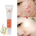 Acne Cream Acne Removal Eliminate Acne Marks Repair Damaged Skin Moisturizing Nourishing Whitening Skin Rejuvenating Face Care