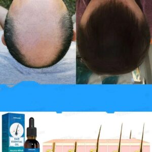 Unisex Hair Growth Oil Hair Loss Treatment Rapid Hair Growth Effective Baldness Repair Hereditary Postpartum Hair Loss