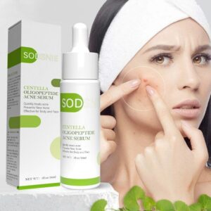 Acne Serum Remove Acne Lighten Acne Marks Relieve Redness Pimples Balance Oil Secretion Facial Care