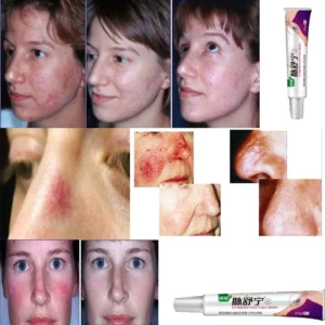 Facial Varicose Vein Cream Anti Redness Spider Vein Remover Advanced Treatment Clearer Skin Veins