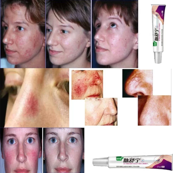 Facial Varicose Vein Cream Anti Redness Spider Vein Remover Advanced Treatment Clearer Skin Veins