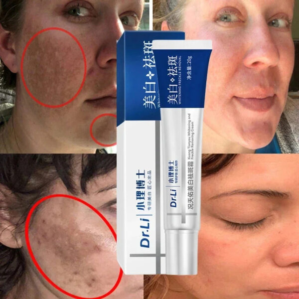 Whiten Freckle Cream Effective Lighten Face Melasma Dark Spot Pigment Stain Corrector Cream Melanin Brighten Moisturize SkinCare