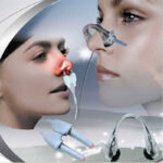 Therapy Machine Allergy Reliever Low Frequency Laser Hay Fever Sinusitis Treatment Device Nose Care Massager Machine