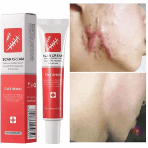 Effective Scar Removal Cream Treatment Stretch Marks Burn Surgical Scar Ointment Acne Spot Repair Gel Whitening Smooth