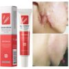 Fast Scar Removal Cream Treatment Stretch Marks Burn Surgical Scar Acne Spots Repair Gel Whitening Moisturizing Smooth Skin Care