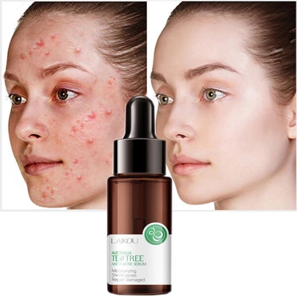 Tea Tree Anti-Acne Serum Whitening Moisturizing Shrinking Pores Oil Control Anti-Inflammatory Fade Acne Marks Skin Care