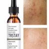 Solution Essence Acne Spot Removing Shrink Pores Oil-Control Brighten Face Skin vitamin c serum for face