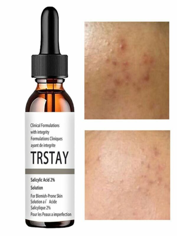 Solution Essence Acne Spot Removing Shrink Pores Oil-Control Brighten Face Skin vitamin c serum for face