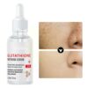 Whitening Freckle Serum Remove Melasma Dark Serum Whitening C Nicotinamide Spots Kojic Face Acid