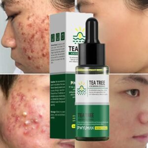 Body Acne Removal Serum Treatment Face Butt Back Acne Remover Pores Shrinking Essence Oil Control Whitening Smooth Skin Care