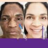 Whitening and freckle removal laser pen effectively removes various spots