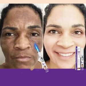 Whitening and freckle removal laser pen effectively removes various spots
