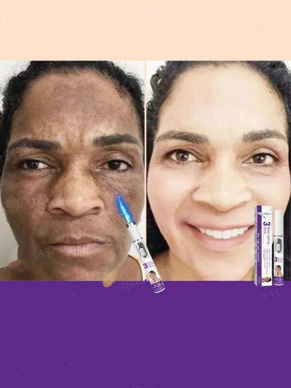 Whitening and freckle removal laser pen effectively removes various spots