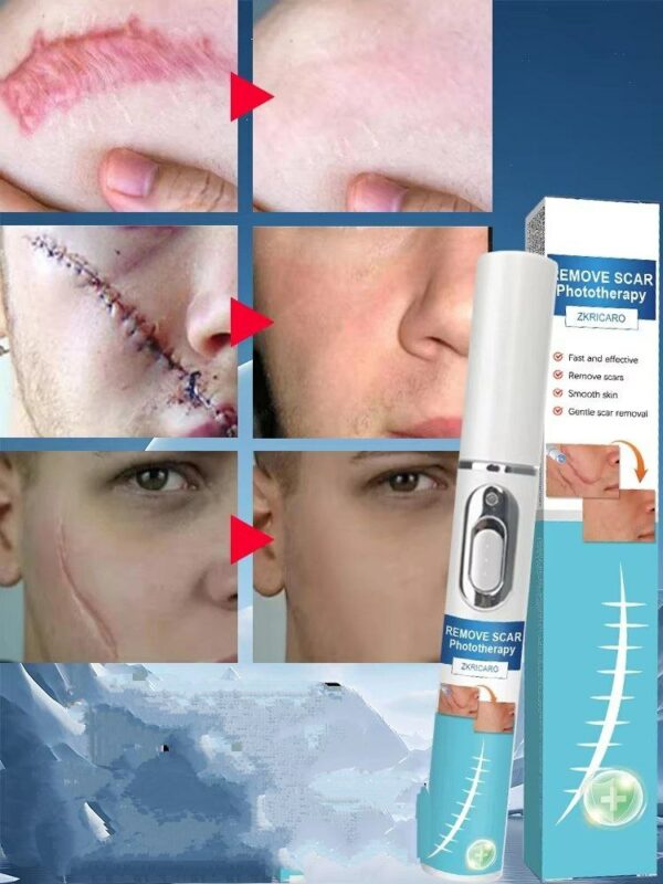 Portable blue light laser scar removal