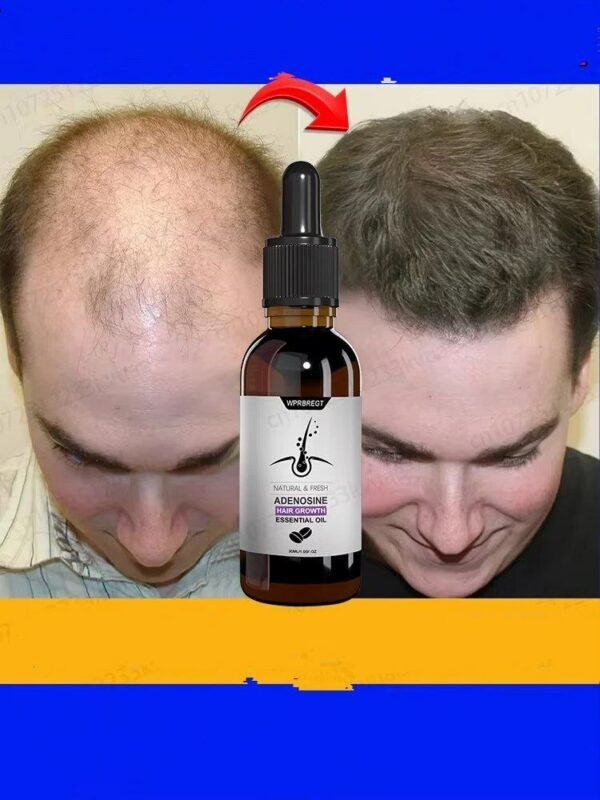 Cares For Men's And Women's Hair, Restores Hair And Activates Hair Follicles