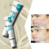 Acid Anti-Acne Gel Acne Removal Cream Remove Pimple Blackhead Treatment Shrink Pore Oily Control Skin Care