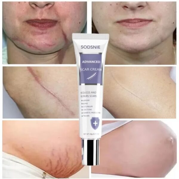 Powerful Scar Removal Cream Heal Old Deep Keloid Scar Treat Stretch Marks Burn Surgical Acne Spot Repair Whiten Skin Care