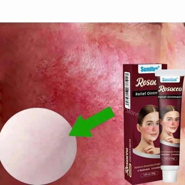 Facial Redness Cream Instant Spider Vein Remove Sensitive Skin Sooth Anti Redness Rosacea Treat Lotion Korean Cosmetics