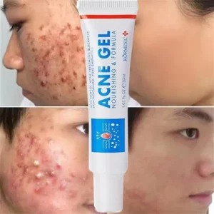 Acid Acne Treatment Face Cream Repair Pimple Spots Deep Cleaning Pore Anti-acne Scar Oil Control Moisturizer Skin Care